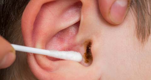 Why It’s Important to Remove Ear Wax