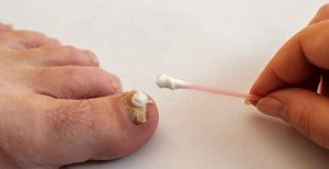Read more about the article Toenail Fungus: Prevent And Cure it Cheaply